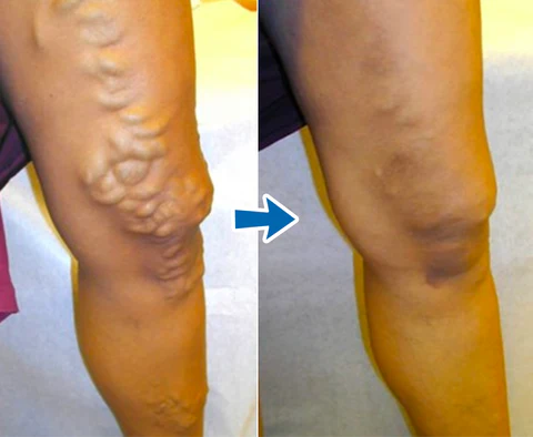 VENALIS™ Crème topique anti-varices & jambes lourdes