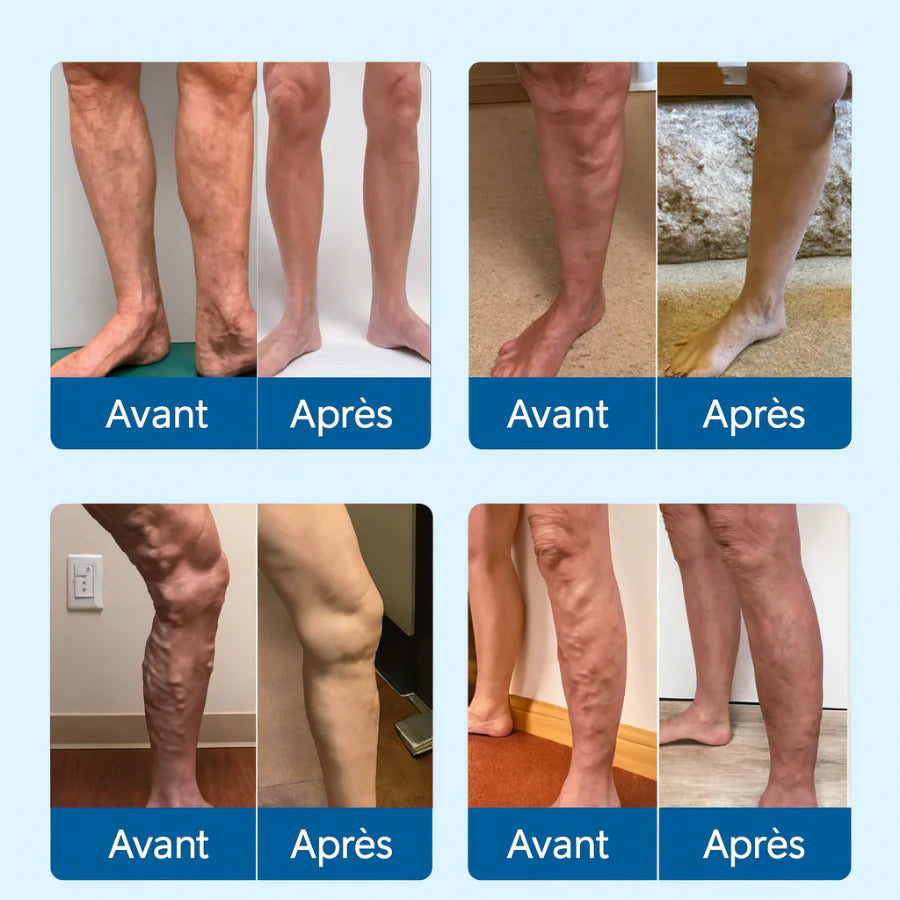 VENALIS™ Crème topique anti-varices & jambes lourdes